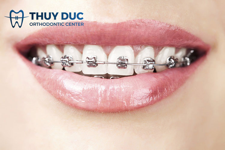 Niềng răng mắc cài kim loại 1 Niềng răng mắc cài kim loại 1