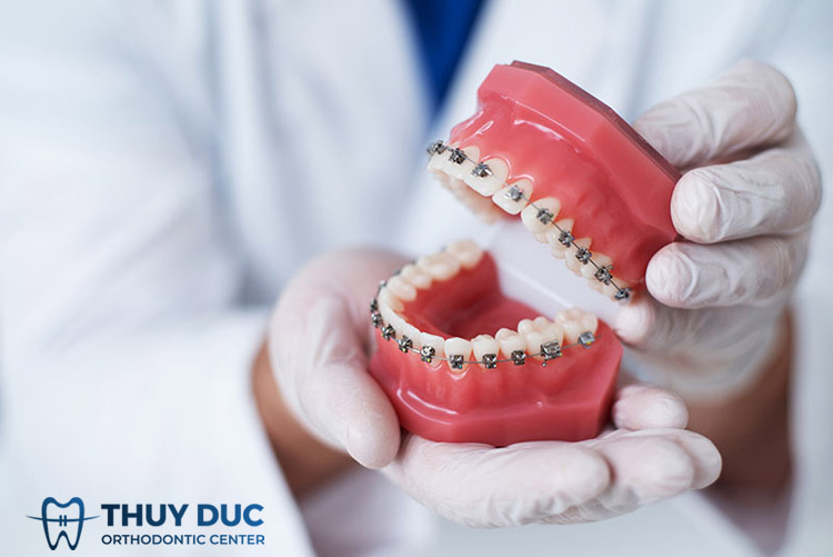 Niềng răng mắc cài kim loại tự đóng (tự buộc) 1 Niềng răng mắc cài kim loại tự đóng (tự buộc) 1