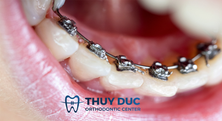 Chi phí niềng răng mặt trong 1