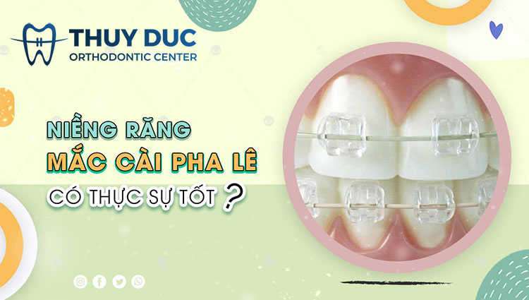 Niềng răng mắc cài pha lê có tốt không? Giá bao nhiêu 1 Niềng răng mắc cài pha lê có tốt không? Giá bao nhiêu 1