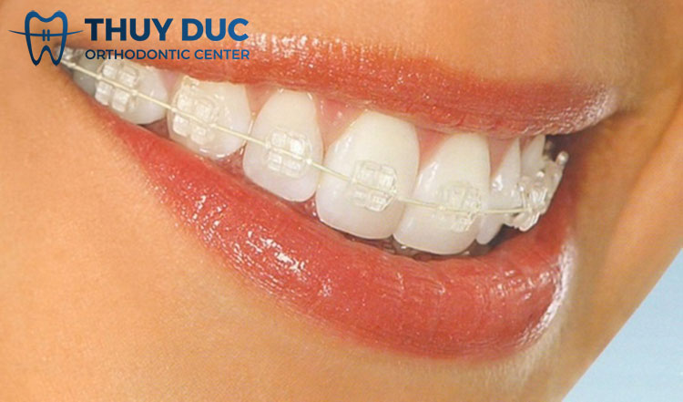 Ưu điểm của niềng răng mắc cài pha lê 1 Ưu điểm của niềng răng mắc cài pha lê 1
