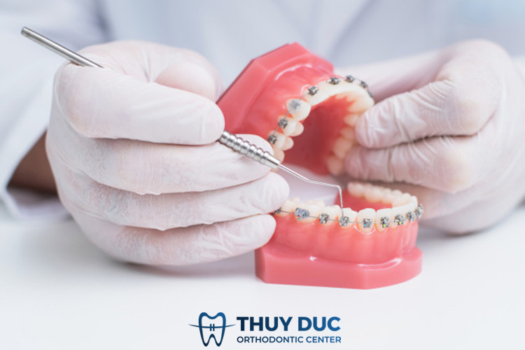 Niềng răng mắc cài kim loại sẽ cảm thấy đau 1 Niềng răng mắc cài kim loại sẽ cảm thấy đau 1