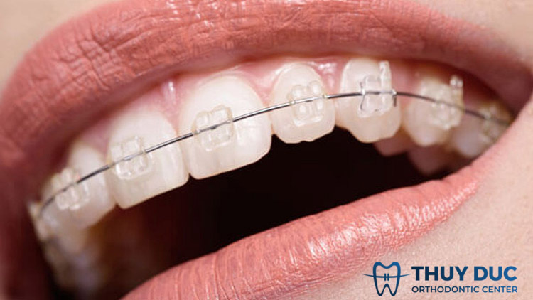Niềng răng mắc cài sứ 1