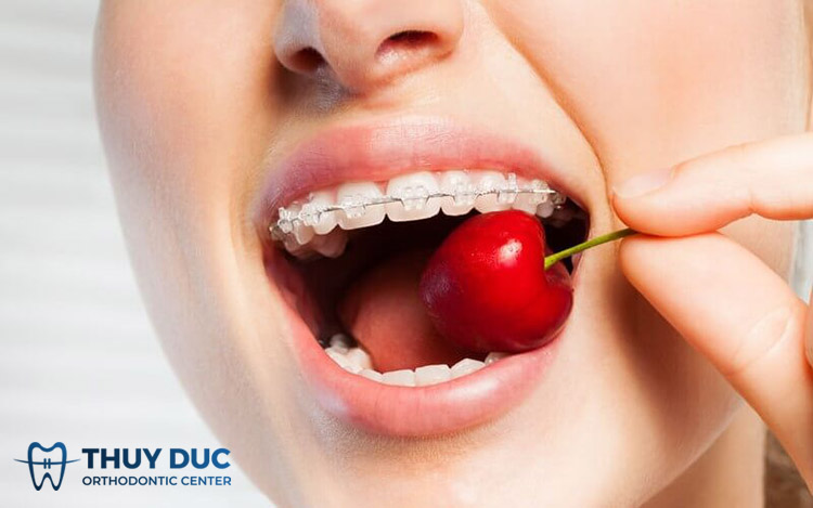 5. Lưu ý chăm sóc răng sau khi niềng răng và khi đeo hàm duy trì 1 5. Lưu ý chăm sóc răng sau khi niềng răng và khi đeo hàm duy trì 1