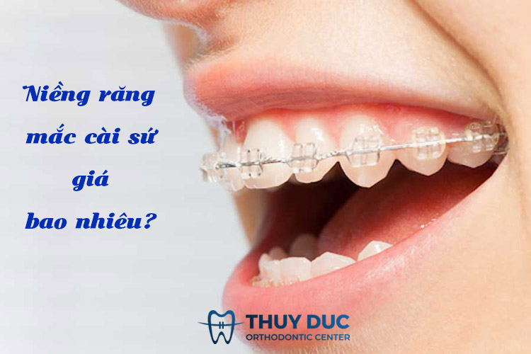 Niềng răng mắc cài sứ giá bao nhiêu? 1 Niềng răng mắc cài sứ giá bao nhiêu? 1