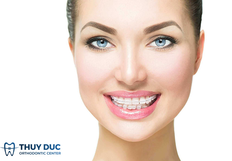 Niềng răng mắc cài sứ có tốt không? 1 Niềng răng mắc cài sứ có tốt không? 1