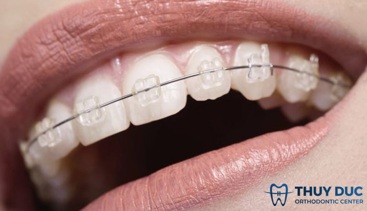 Niềng răng mắc cài sứ tự buộc 1 Niềng răng mắc cài sứ tự buộc 1
