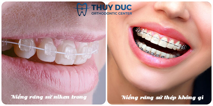 Niềng răng mắc cài sứ là gì? 1 Niềng răng mắc cài sứ là gì? 1