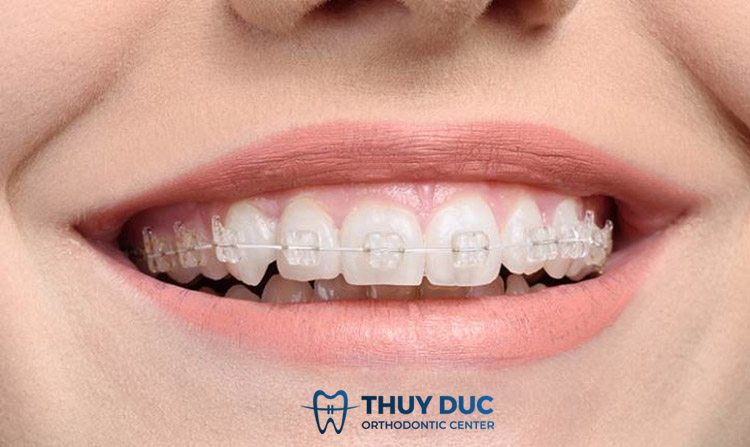Niềng răng mắc cài sứ truyền thống 1 Niềng răng mắc cài sứ truyền thống 1