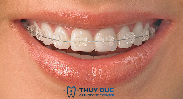 Niềng răng mắc cài sứ truyền thống 1 Niềng răng mắc cài sứ truyền thống 1