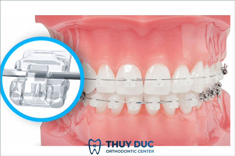 Niềng răng mắc cài sứ tự buộc 1 Niềng răng mắc cài sứ tự buộc 1