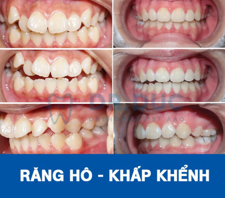 Niềng răng mắc cài chất lượng tại Nha khoa Thúy Đức 3 Niềng răng mắc cài chất lượng tại Nha khoa Thúy Đức 3