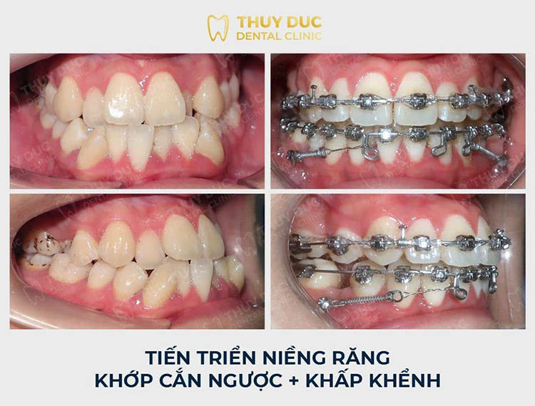 Niềng răng mắc cài chất lượng tại Nha khoa Thúy Đức 2 Niềng răng mắc cài chất lượng tại Nha khoa Thúy Đức 2