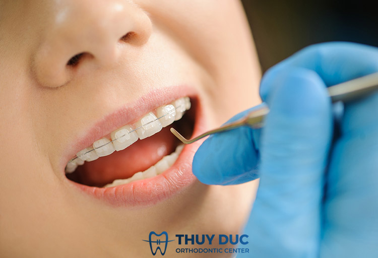 Niềng răng ở cơ sở kém chất lượng 1 Niềng răng ở cơ sở kém chất lượng 1