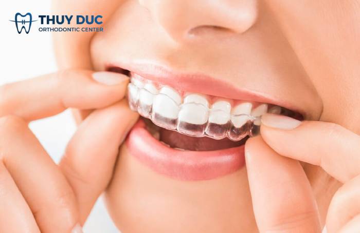 Chỉnh nha tháo lắp trong suốt 1 Chỉnh nha tháo lắp trong suốt 1