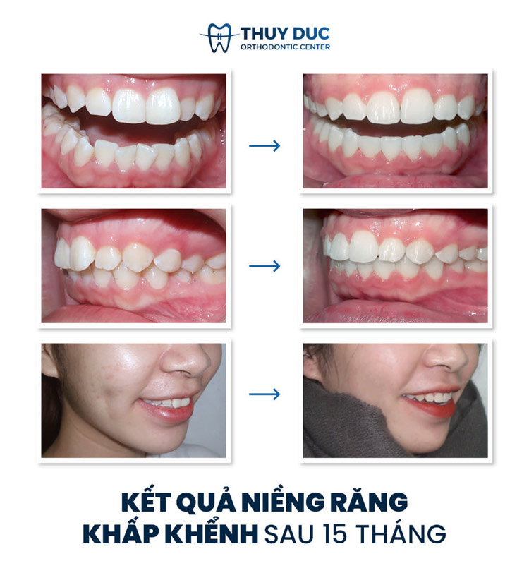 Liệu có nên niềng răng hay không? 1 Liệu có nên niềng răng hay không? 1