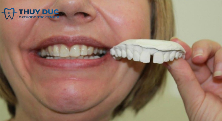 Vì sao nên sớm khắc phục tình trạng răng thưa? 1