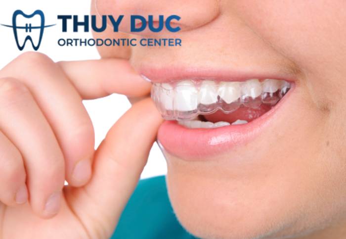 Niềng răng eCligner 1 Niềng răng eCligner 1