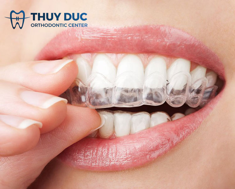 Thời gian niềng răng mất bao lâu? 2 Thời gian niềng răng mất bao lâu? 2