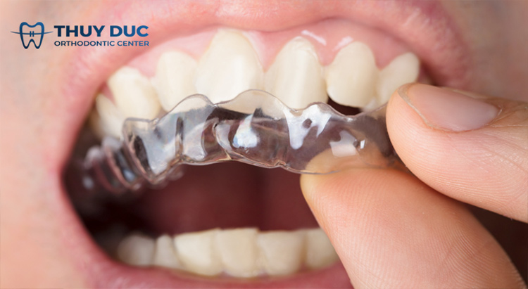 Niềng răng trong suốt 1 Niềng răng trong suốt 1