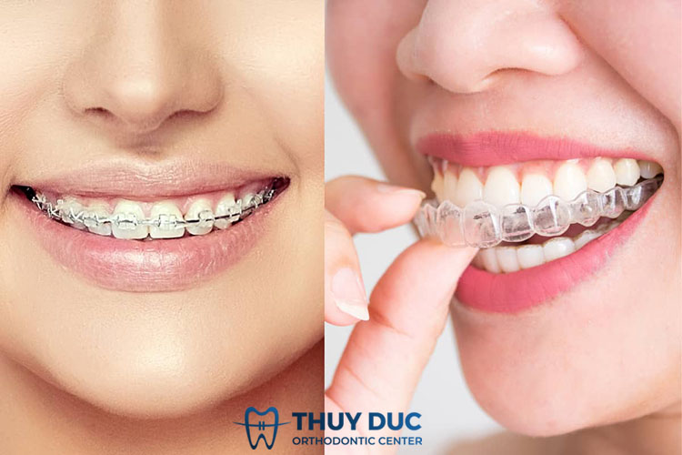 Khí cụ chỉnh nha là gì? 1