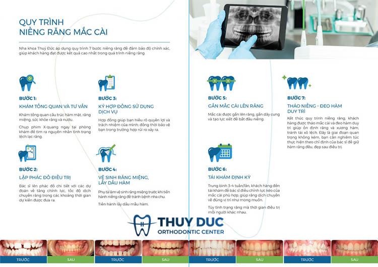 Quy trình niềng răng mắc cài sứ chuẩn nhất 1 Quy trình niềng răng mắc cài sứ chuẩn nhất 1
