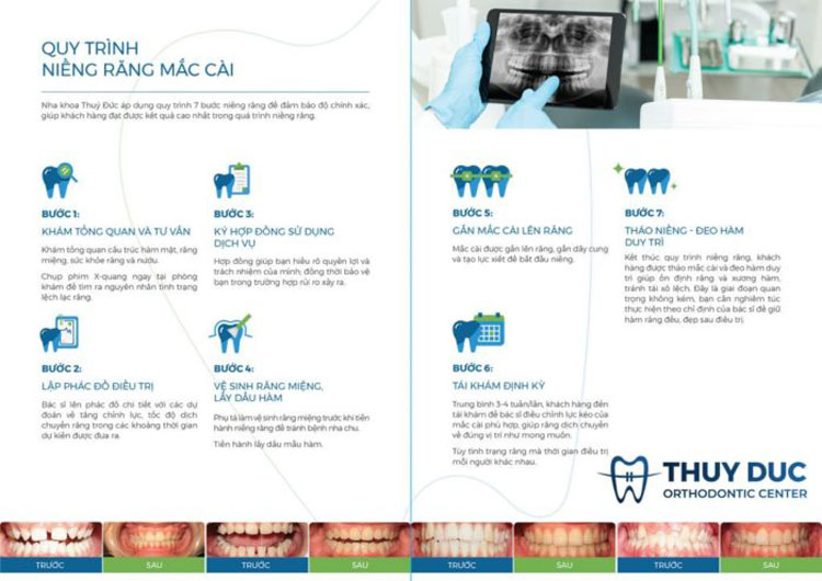 Quy trình niềng răng mắc cài 1 Quy trình niềng răng mắc cài 1
