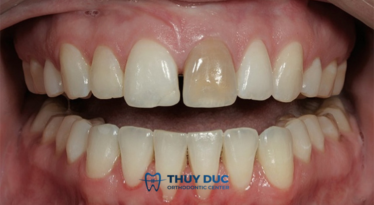 Răng chết tủy là gì? 1 Răng chết tủy là gì? 1