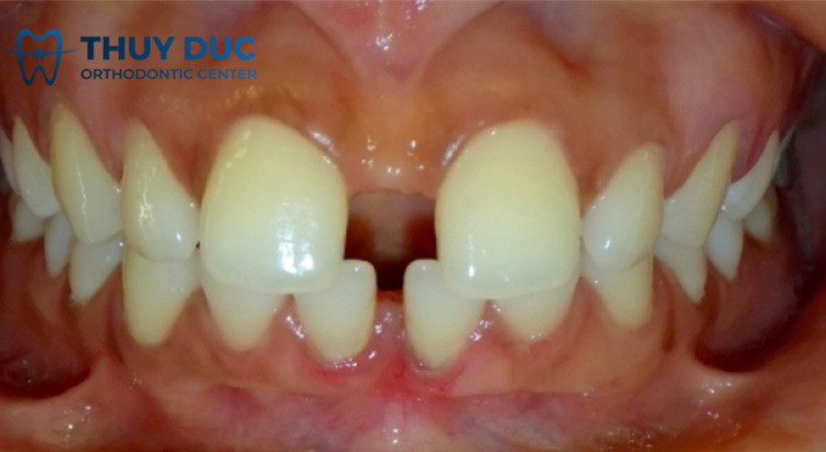 Niềng răng thưa hết bao nhiêu tiền? 1