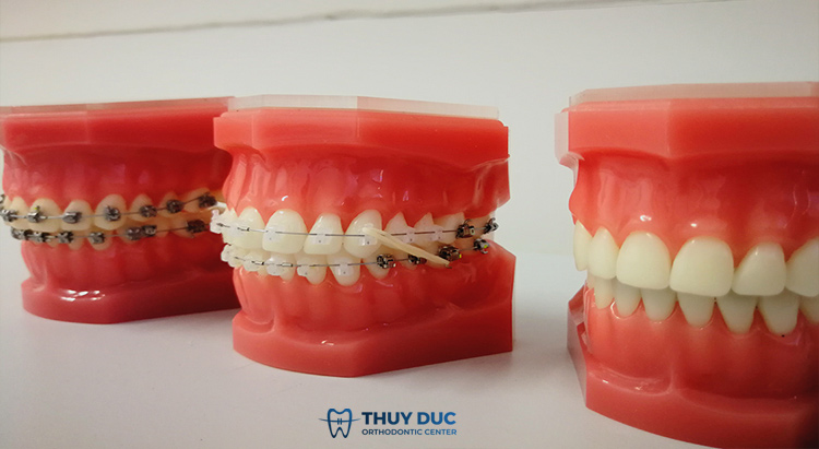 Các yếu tố tác động khiến răng có thể bị dịch chuyển sau khi niềng răng 1