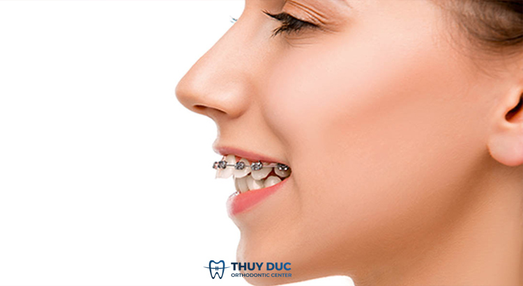 Tại sao răng hô trở lại sau khi niềng răng? 1