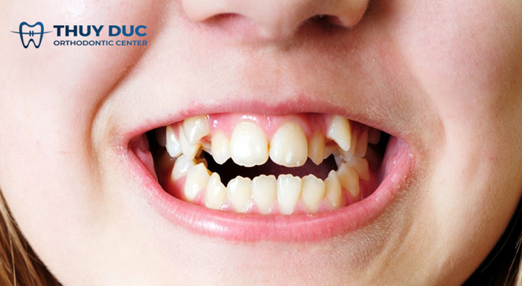 Răng khấp khểnh là gì? 1 Răng khấp khểnh là gì? 1