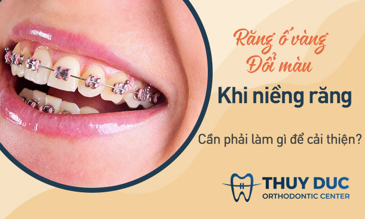 Bí quyết khắc phục tình trạng răng bị ố vàng, đổi màu sau khi niềng răng 1 Bí quyết khắc phục tình trạng răng bị ố vàng, đổi màu sau khi niềng răng 1
