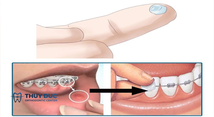 1. Sử dụng sáp chỉnh nha 1 1. Sử dụng sáp chỉnh nha 1