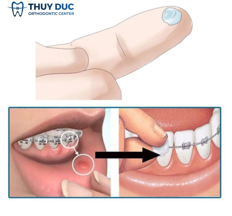 Sáp nha khoa là một cứu cánh tuyệt vời 1 Sáp nha khoa là một cứu cánh tuyệt vời 1