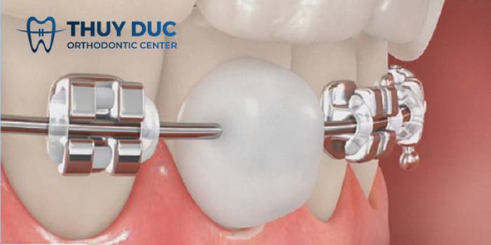 Phải làm gì khi dây cung bị tuột? 1 Phải làm gì khi dây cung bị tuột? 1