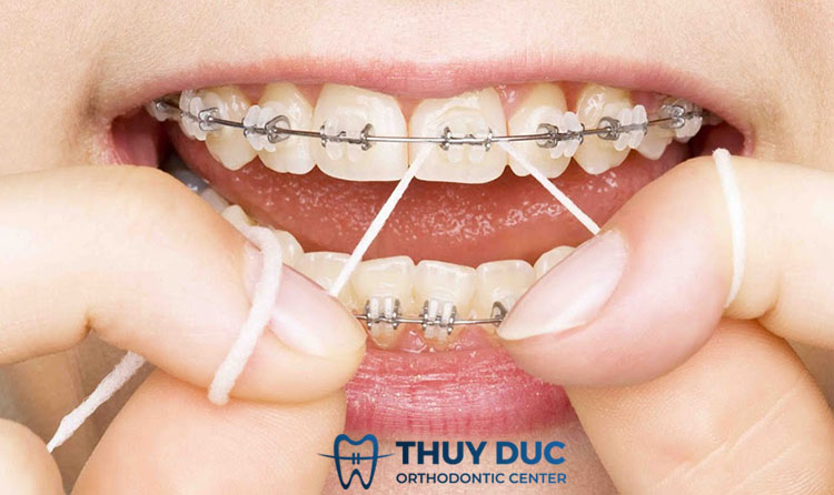 Dùng chỉ nha khoa là một thách thức 1 Dùng chỉ nha khoa là một thách thức 1