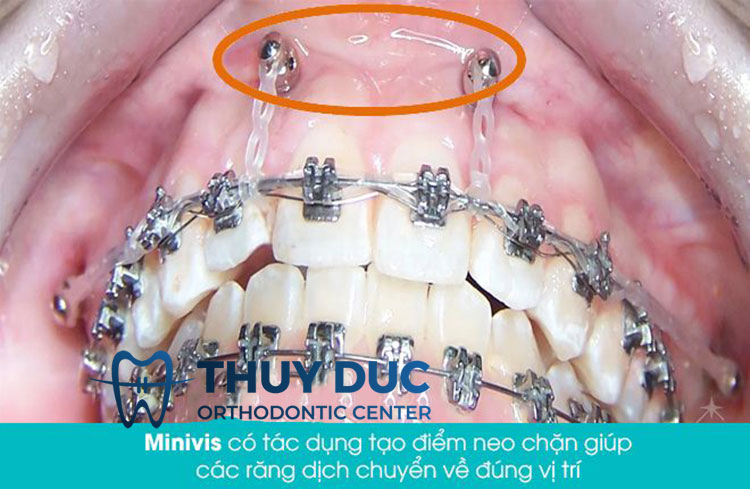 Sử dụng minivis chỉnh nha 1 Sử dụng minivis chỉnh nha 1