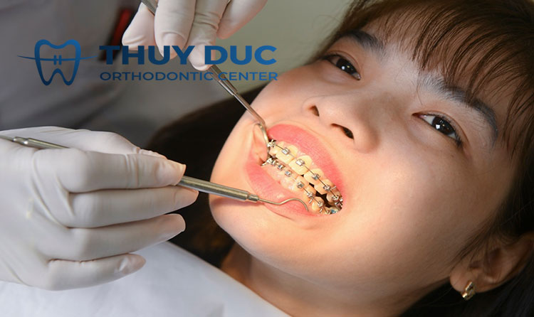 Phải làm gì khi dây cung bị tuột? 2 Phải làm gì khi dây cung bị tuột? 2