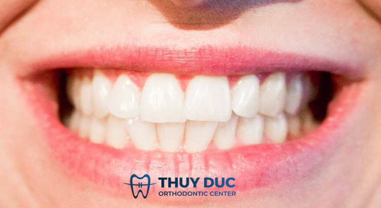 2. Tại sao sau khi niềng răng có thể bị chạy răng? 1 2. Tại sao sau khi niềng răng có thể bị chạy răng? 1