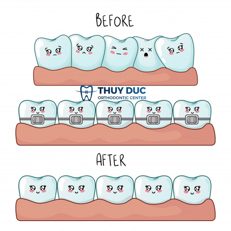 Thời gian niềng răng trung bình của trẻ 1