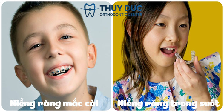 Các yếu tố ảnh hưởng đến thời gian niềng răng của trẻ 1
