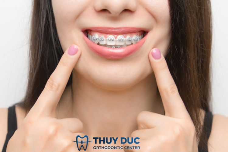 Thời gian chỉnh nha khoảng bao lâu? 1 Thời gian chỉnh nha khoảng bao lâu? 1