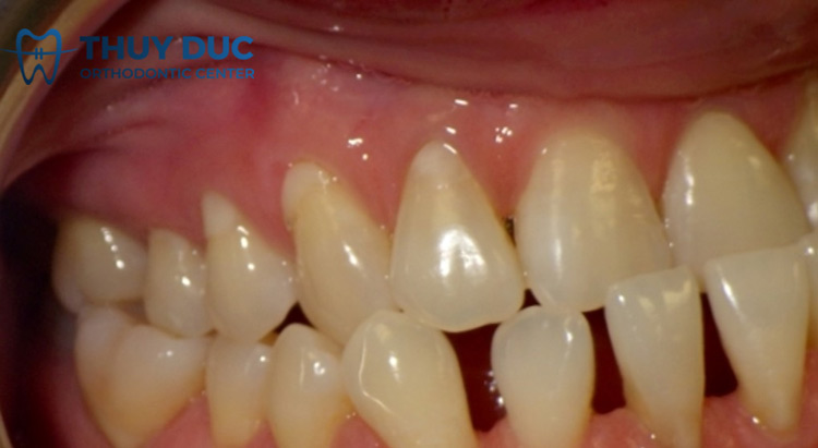 Nguyên nhân của tình trạng răng thưa là gì? 1