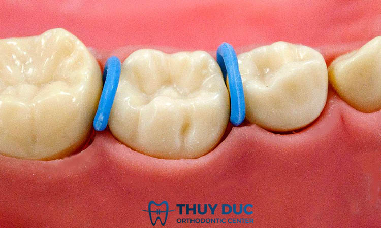 Niềng răng giai đoạn nào đau nhất? 1 Niềng răng giai đoạn nào đau nhất? 1