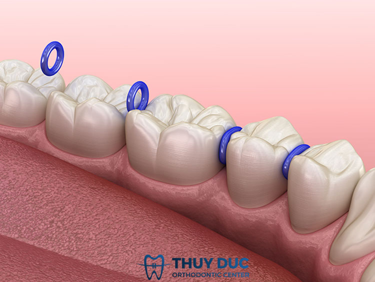 Tổng kết những câu hỏi thường gặp với thun tách kẽ 1 Tổng kết những câu hỏi thường gặp với thun tách kẽ 1