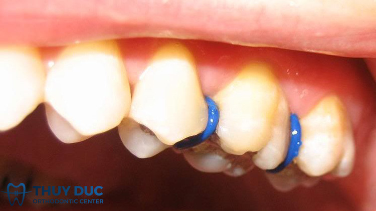 Trường hợp nào phải đặt thun tách kẽ? 1 Trường hợp nào phải đặt thun tách kẽ? 1