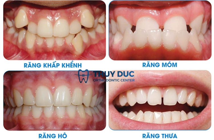 Những trường hợp thích hợp niềng răng trong suốt 1