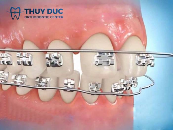 Tuột dây cung khi niềng răng - hướng dẫn xử lý đúng cách 1 Tuột dây cung khi niềng răng - hướng dẫn xử lý đúng cách 1