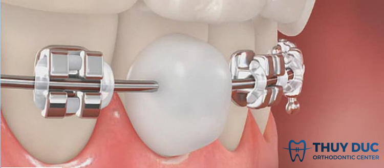 Các vấn đề có thể xảy ra khi niềng răng cho trẻ và cách xử lý 1 Các vấn đề có thể xảy ra khi niềng răng cho trẻ và cách xử lý 1